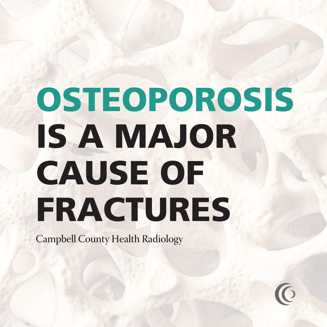 Osteoporosis Is The Major Cause Of Fractures In Elderly Patients 5433